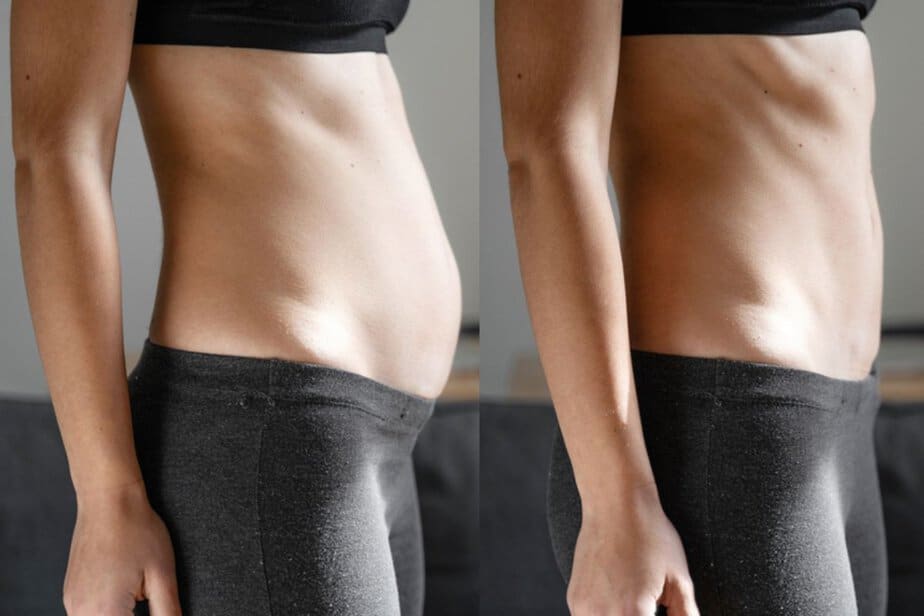 diastasis-recti