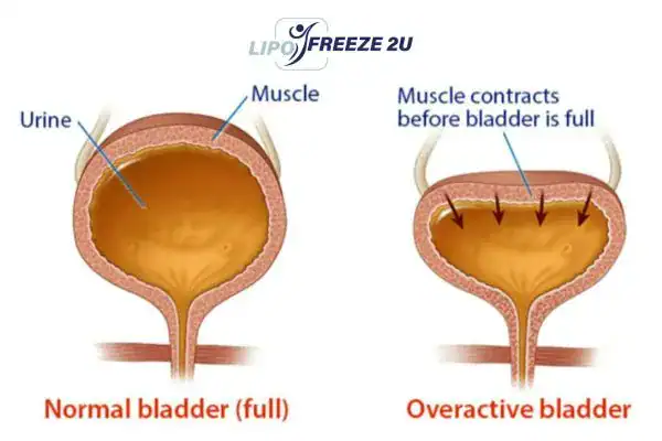 diagram of overactive bladder treatment Stourbridge