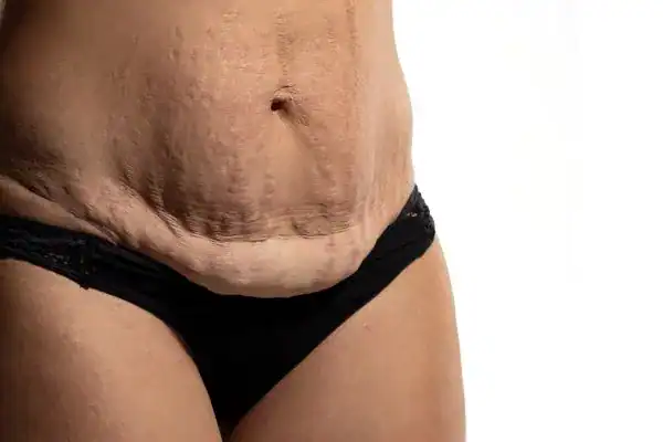 loose skin after weight loss injections Stourbridge
