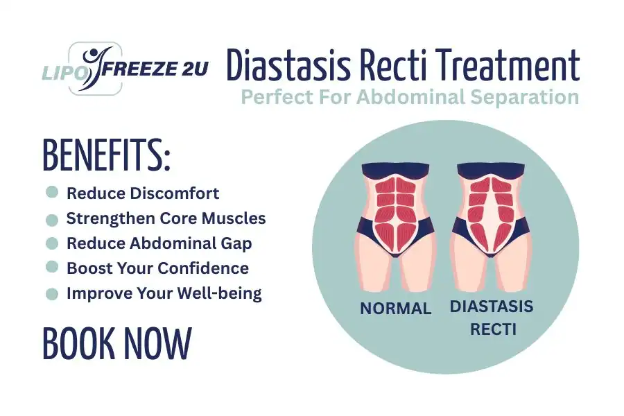 How Long Will It Take to See Improvements in Diastasis Recti Stourbridge