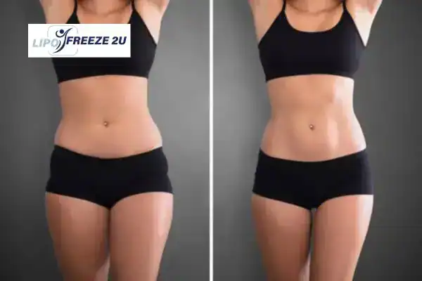 How Can LIPO FREEZE 2U Support Your Post-Pregnancy Body Recovery Stourbridge?