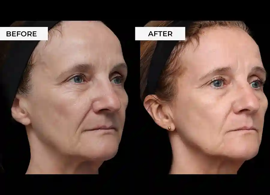 How Many RF Microneedling Sessions Will You Need to See a Difference Stourbridge?