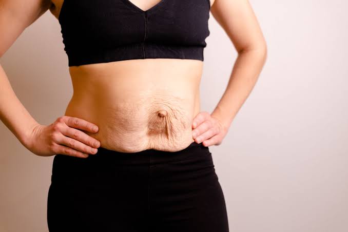 Is Surgery Really the Only Way to Repair Diastasis Recti Stourbridge?